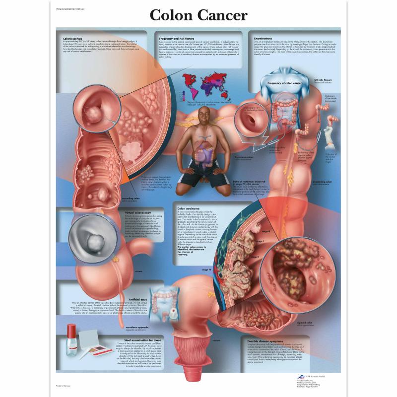 All Products - Wandkaart: Colon Cancer