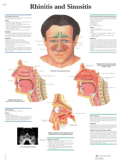 Wandkaart: Rhinitis And Sinusitis