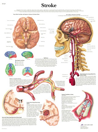 Wandkaart: Stroke